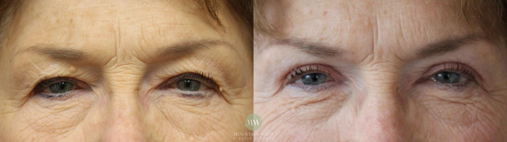 Before & After Blepharoplasty Case 195 Front View in Kalispell, MT