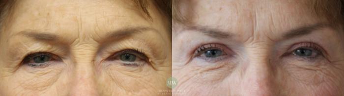 Before & After Blepharoplasty Case 195 Front View in Kalispell, MT