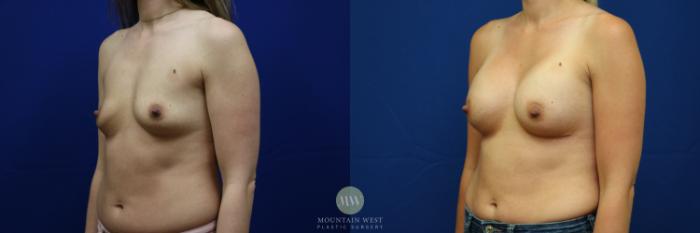 Before & After Breast Augmentation Case 72 View #1 View in Kalispell, MT