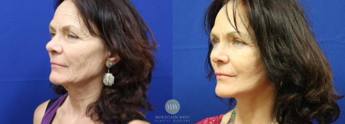 Before & After Facelift Case 50 View #1 View in Kalispell, MT