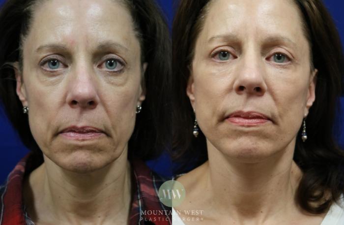 Before & After Facelift Case 65 View #1 View in Kalispell, MT