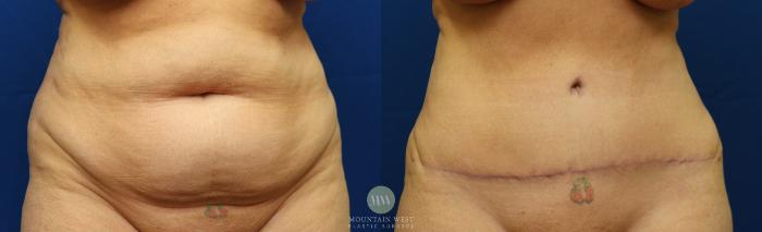 Before & After Tummy Tuck Case 56 View #1 View in Kalispell, MT