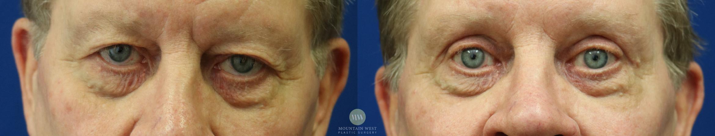 Upper Blepharoplasty Case 53 Before & After View #1 | Kalispell, MT | Mountain West Plastic Surgery