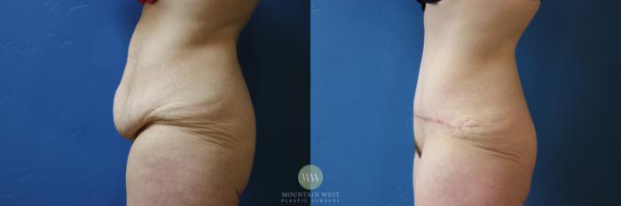 Before & After Abdominoplasty Case 171 Left Side View in Kalispell, MT