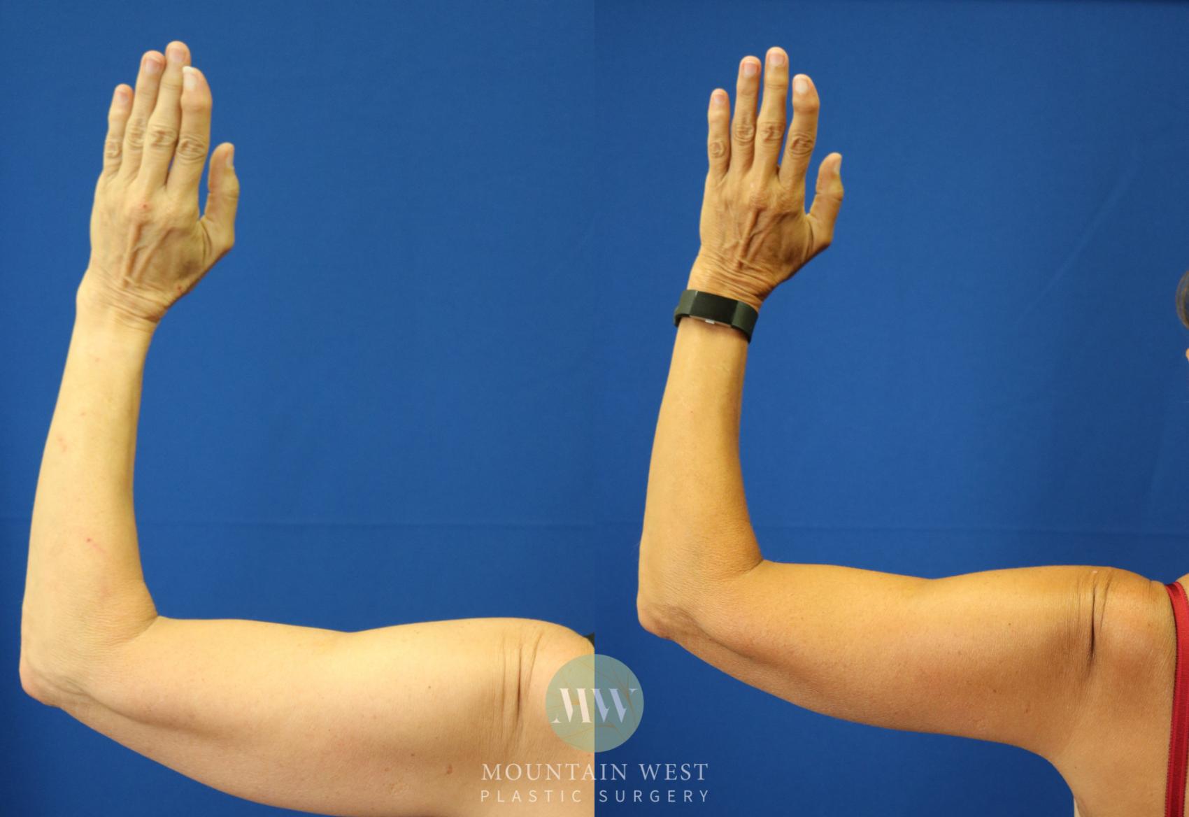 Arm Lift Case 43 Before & After View #1 | Kalispell, MT | Mountain West Plastic Surgery