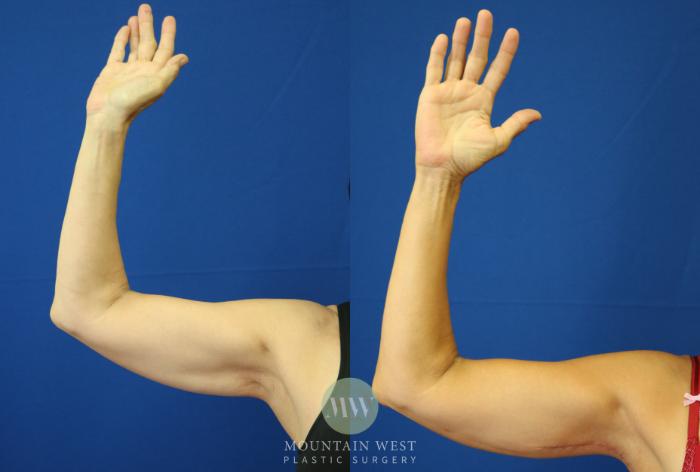 Before & After Arm Lift Case 43 View #2 View in Kalispell, MT