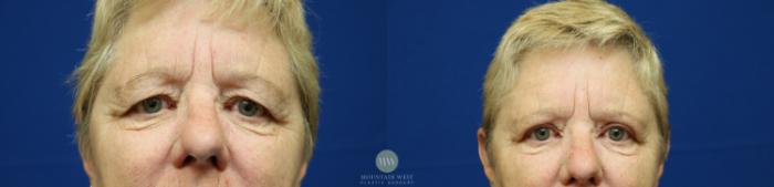 Before & After Blepharoplasty Case 133 Front View in Kalispell, MT
