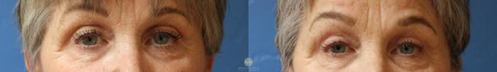 Before & After Blepharoplasty Case 180 Front View in Kalispell, MT