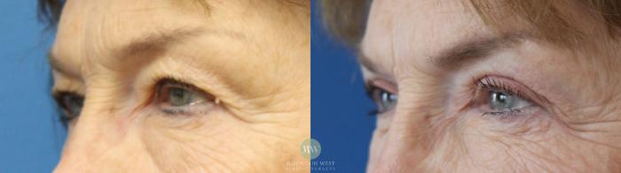 Before & After Blepharoplasty Case 195 Left Oblique View in Kalispell, MT
