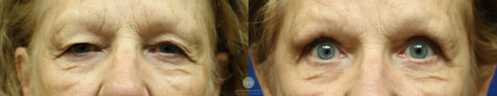 Before & After Blepharoplasty Case 37 View #1 View in Kalispell, MT