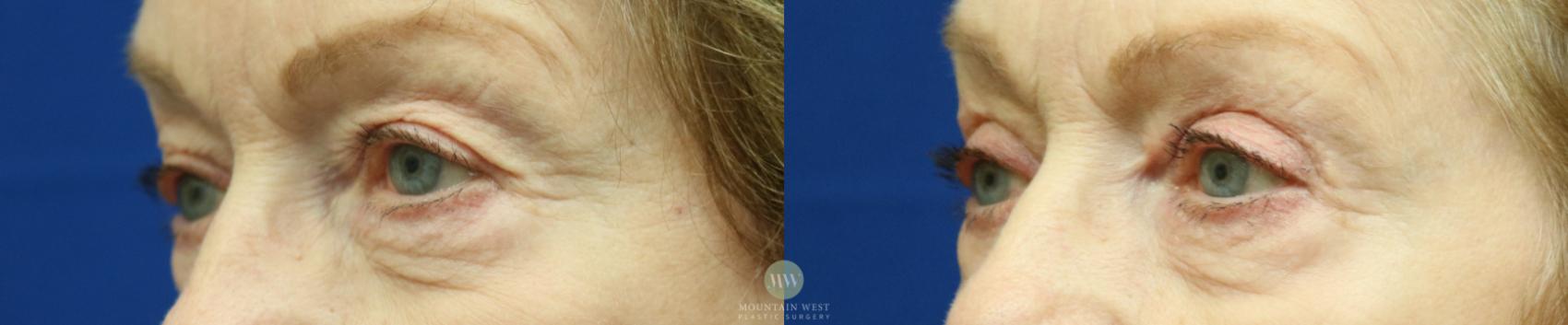 Before & After Blepharoplasty Case 58 View #1 View in Kalispell, MT