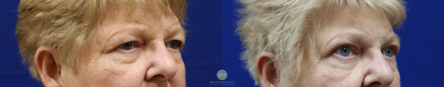 Before & After Blepharoplasty Case 66 View #1 View in Kalispell, MT