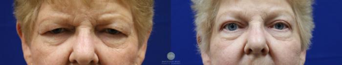 Before & After Blepharoplasty Case 66 View #2 View in Kalispell, MT