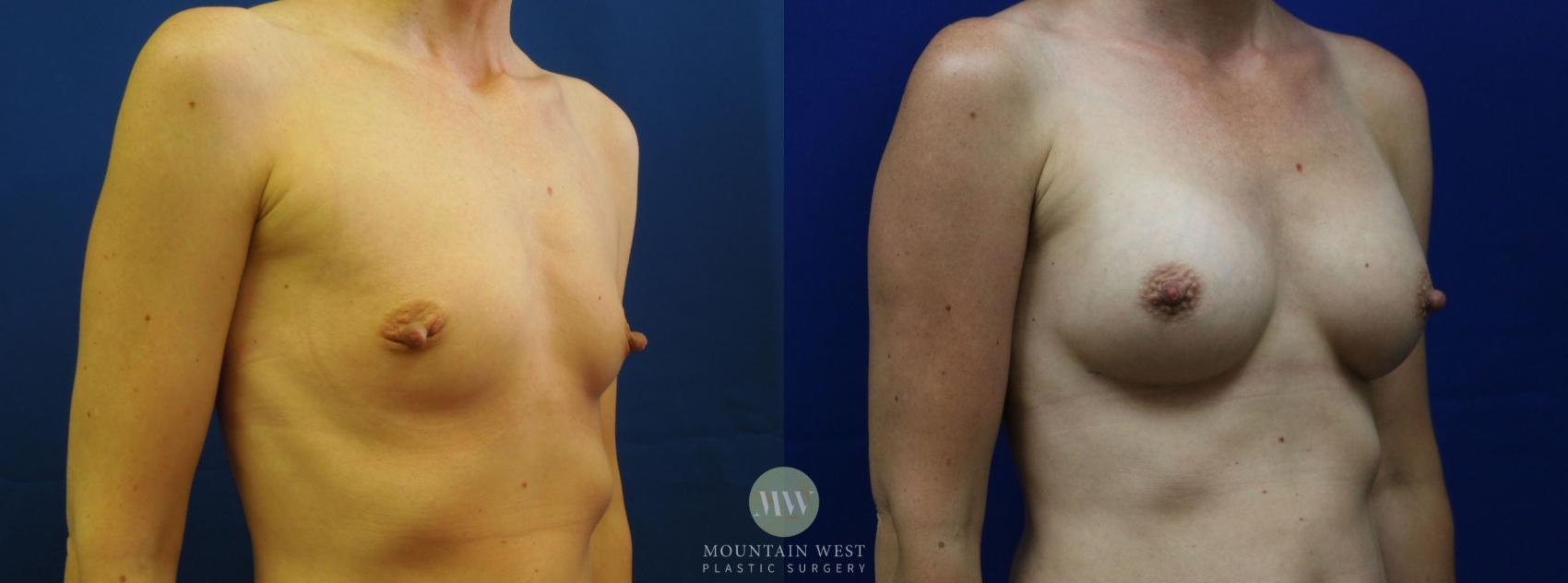 Breast Augmentation Case 10 Before & After View #1 | Kalispell, MT | Mountain West Plastic Surgery