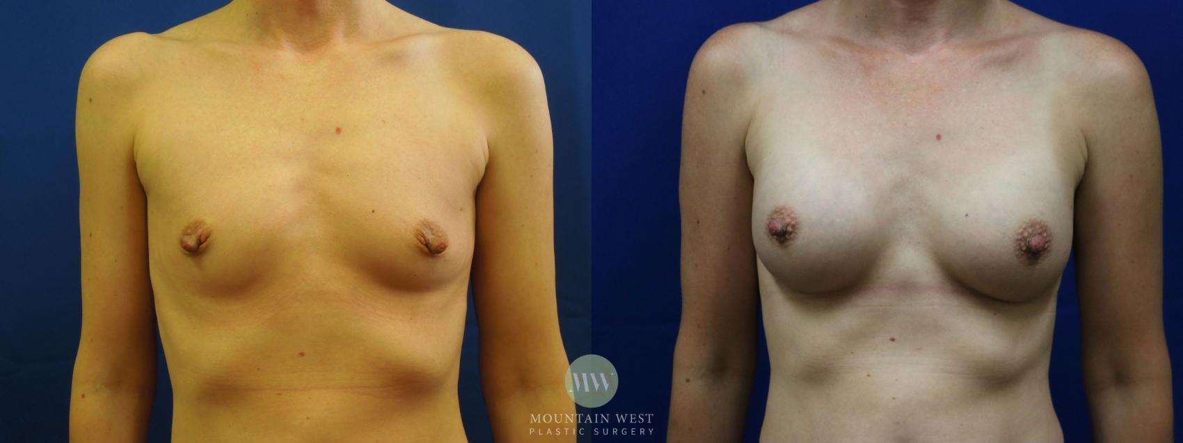 Breast Augmentation Case 10 Before & After View #2 | Kalispell, MT | Mountain West Plastic Surgery