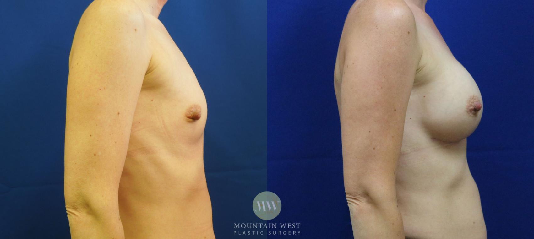 Breast Augmentation Case 10 Before & After View #3 | Kalispell, MT | Mountain West Plastic Surgery