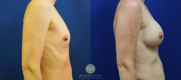 Before & After Breast Augmentation Case 10 View #3 View in Kalispell, MT