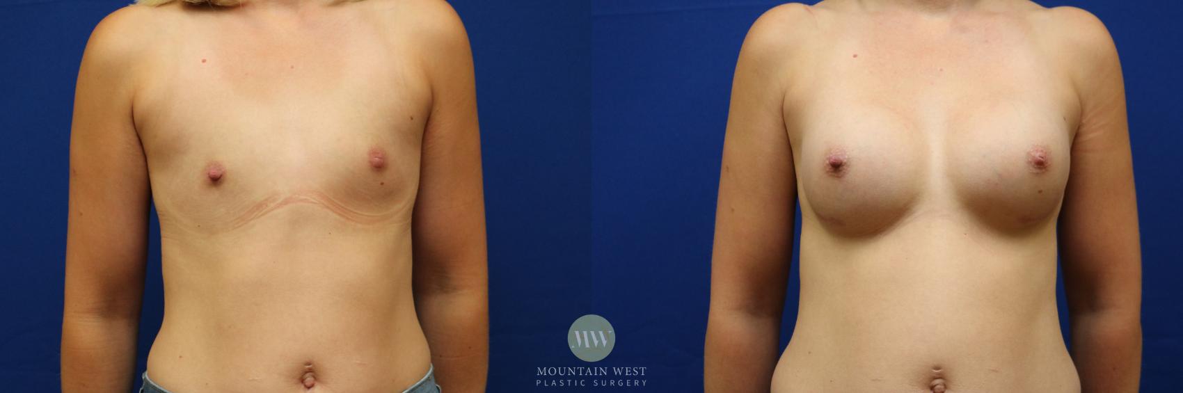 Breast Augmentation Case 100 Before & After Front | Kalispell, MT | Mountain West Plastic Surgery