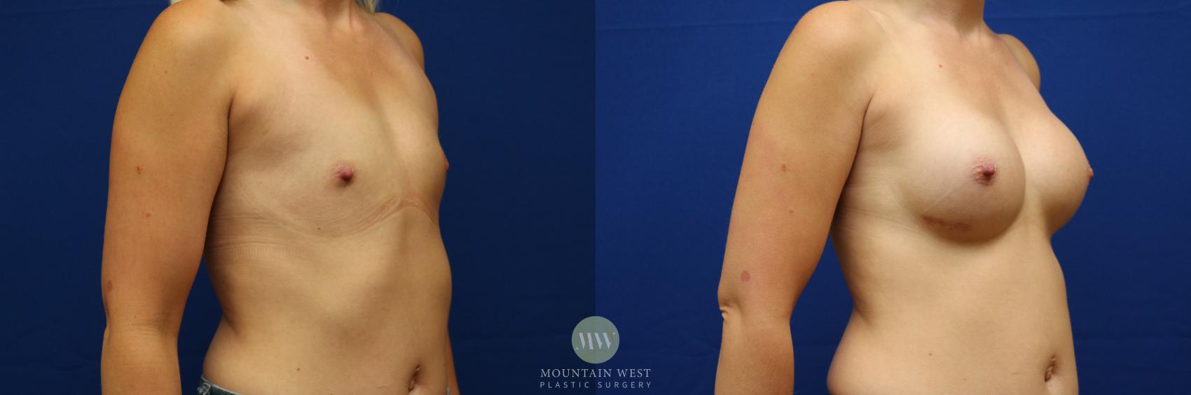 Breast Augmentation Case 100 Before & After Left Oblique | Kalispell, MT | Mountain West Plastic Surgery