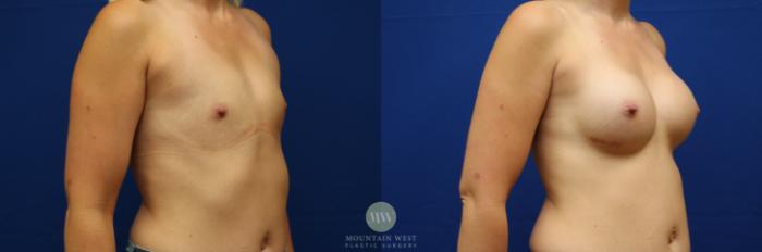 Before & After Breast Augmentation Case 100 Left Oblique View in Kalispell, MT