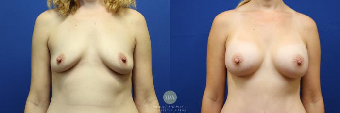 Before & After Breast Augmentation Case 105 Front View in Kalispell, MT