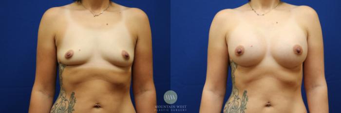 Before & After Breast Augmentation Case 106 Front View in Kalispell, MT