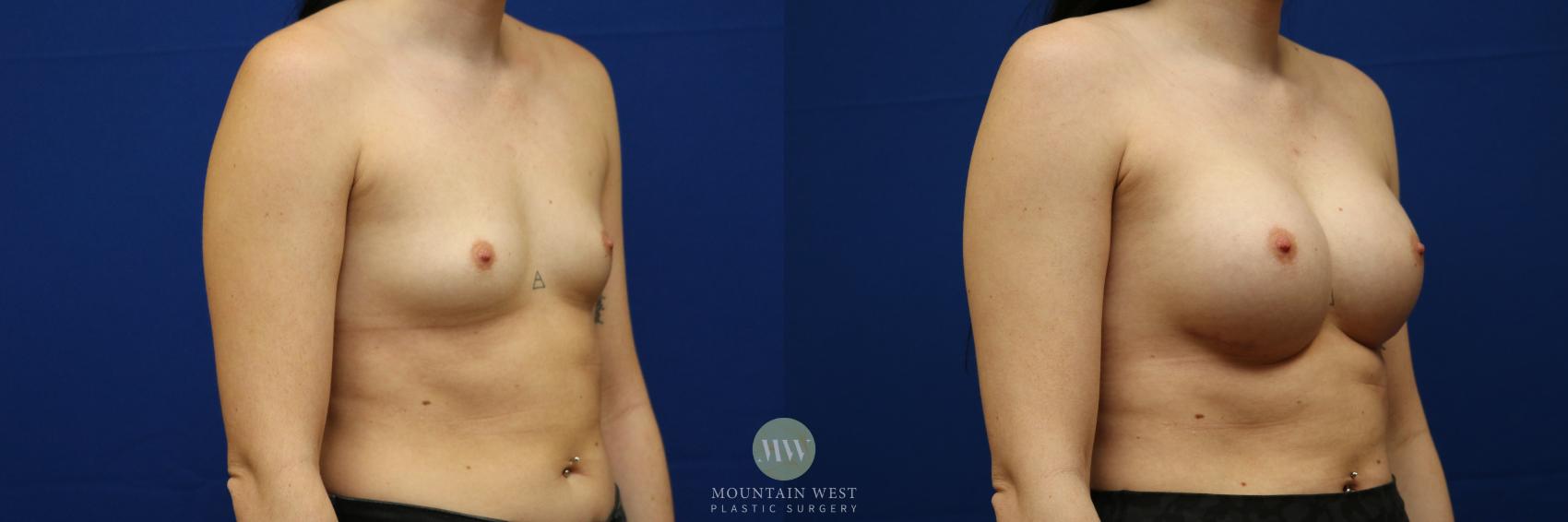 Before & After Breast Augmentation Case 107 Right Oblique View in Kalispell, MT