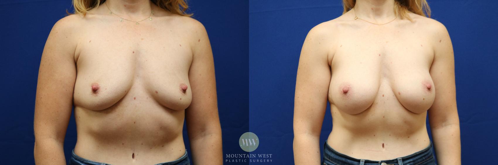 Before & After Breast Augmentation Case 108 Front View in Kalispell, MT