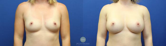 Before & After Breast Augmentation Case 109 Front View in Kalispell, MT
