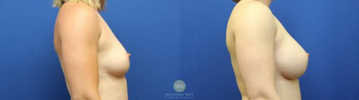 Before & After Breast Augmentation Case 109 Right Side View in Kalispell, MT