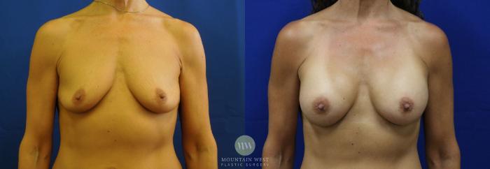 Before & After Breast Augmentation Case 11 View #1 View in Kalispell, MT