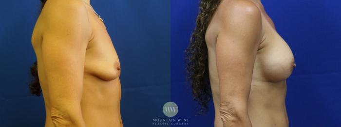 Before & After Breast Augmentation Case 11 View #2 View in Kalispell, MT