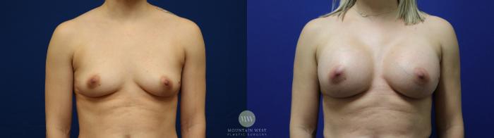 Before & After Breast Augmentation Case 111 Front View in Kalispell, MT