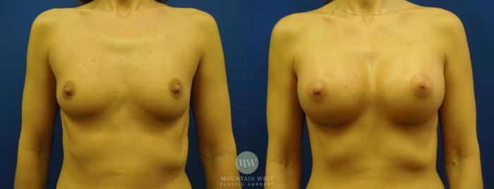 Before & After Breast Augmentation Case 12 View #1 View in Kalispell, MT
