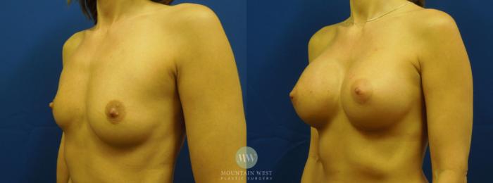 Before & After Breast Augmentation Case 12 View #2 View in Kalispell, MT