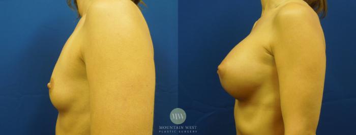 Before & After Breast Augmentation Case 12 View #3 View in Kalispell, MT