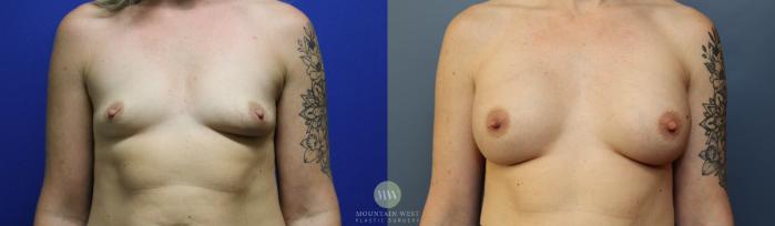 Before & After Breast Augmentation Case 120 Front View in Kalispell, MT