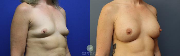 Before & After Breast Augmentation Case 120 Right Oblique View in Kalispell, MT