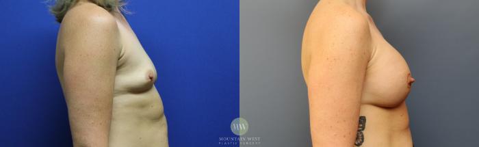 Before & After Breast Augmentation Case 120 Right Side View in Kalispell, MT