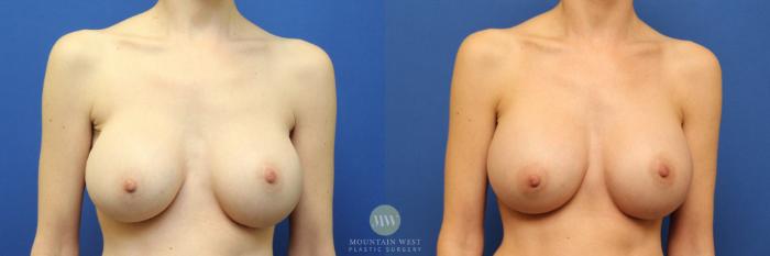 Before & After Breast Augmentation Case 121 Front View in Kalispell, MT