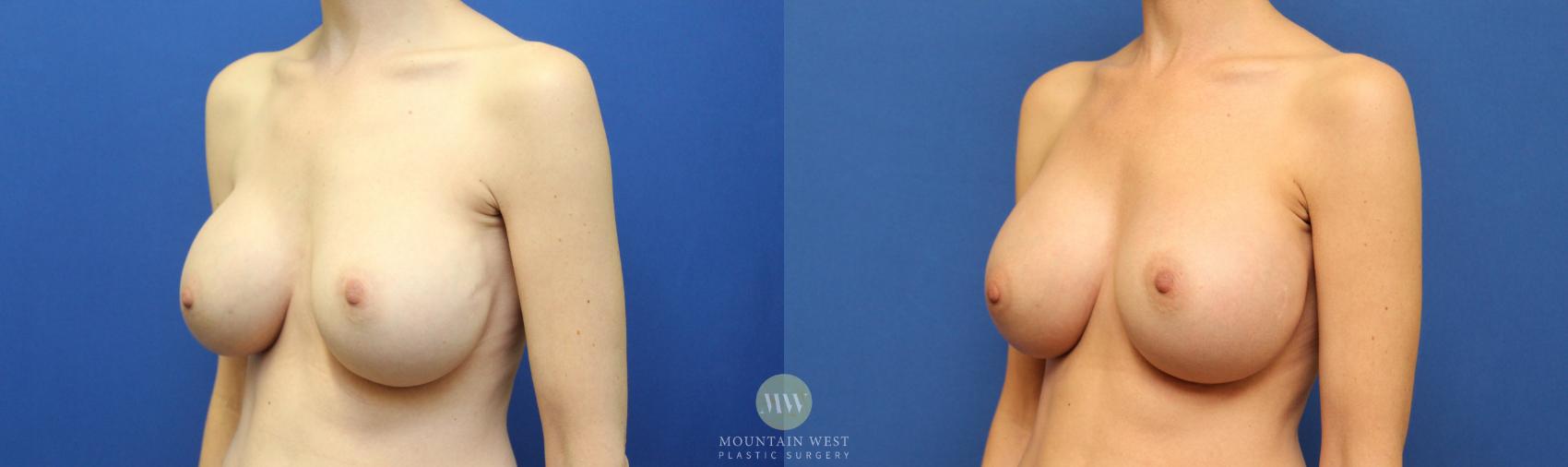 Before & After Breast Augmentation Case 121 Left Oblique View in Kalispell, MT