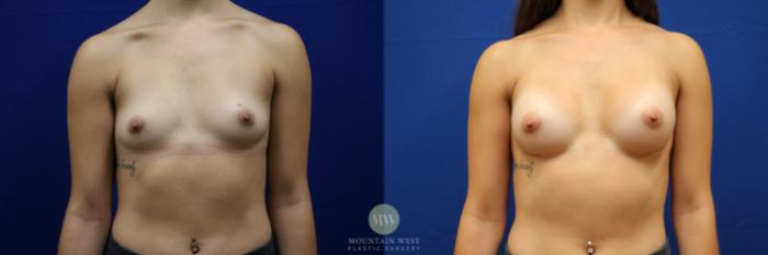 Before & After Breast Augmentation Case 123 Front View in Kalispell, MT