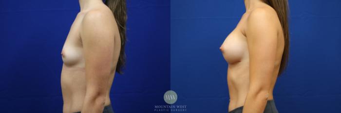 Before & After Breast Augmentation Case 123 Left Side View in Kalispell, MT