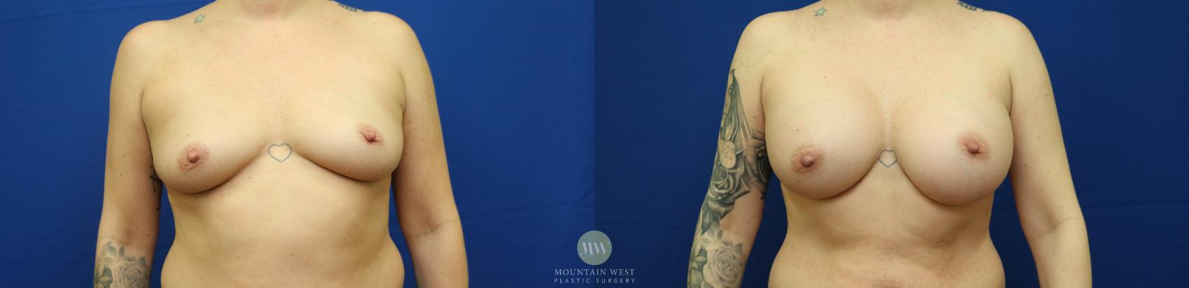 Before & After Breast Augmentation Case 125 Front View in Kalispell, MT