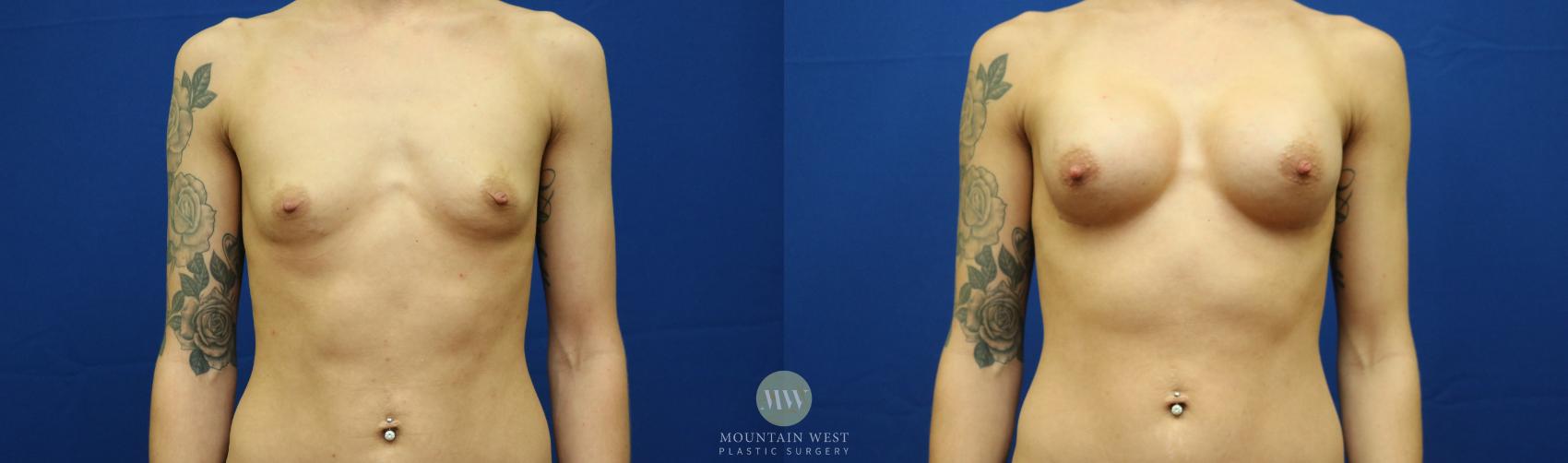 Before & After Breast Augmentation Case 126 Front View in Kalispell, MT