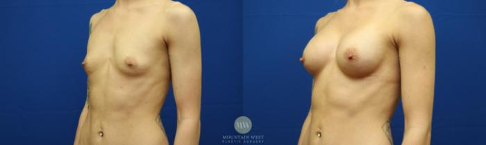 Before & After Breast Augmentation Case 126 Left Oblique View in Kalispell, MT