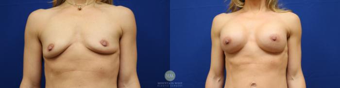 Before & After Breast Augmentation Case 127 Front View in Kalispell, MT