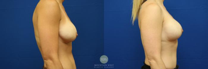 Before & After Breast Augmentation Case 128 Right Side View in Kalispell, MT