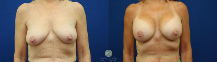 Before & After Breast Augmentation Case 130 Front View in Kalispell, MT