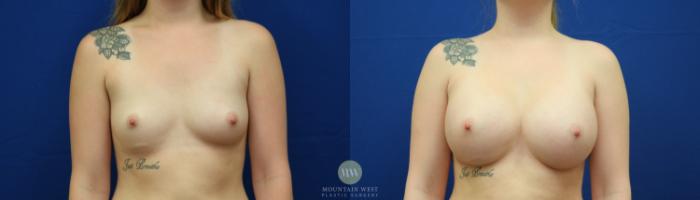 Before & After Breast Augmentation Case 131 Front View in Kalispell, MT